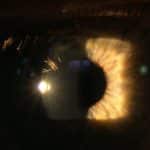 Corneal haze