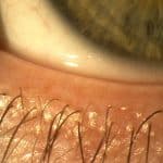 Eyelid margin