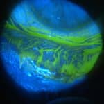 Dry Eye Fluorescein